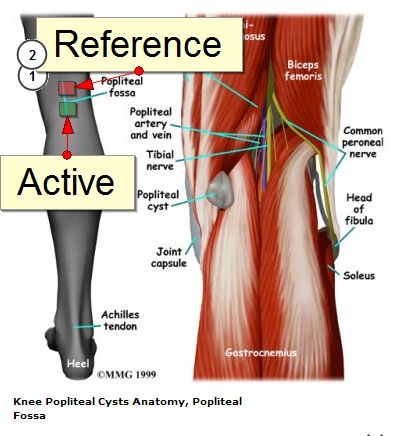 Popliteal Fossa Potential: How and Why To Set It Up