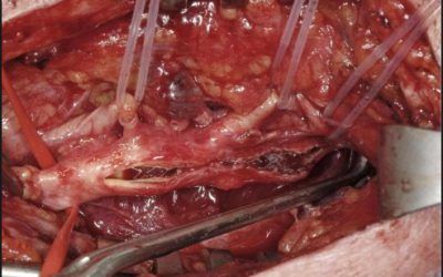 Neuromonitoring Carotid Endarterectomy Surgeries