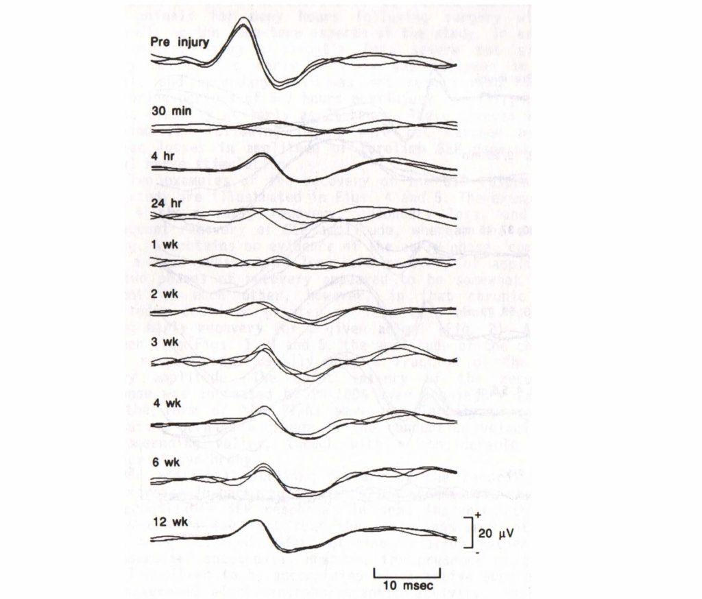 ssep improvement with early loss