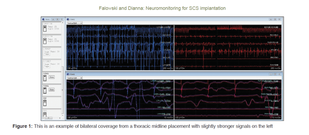 neuromonitoring training for spinal cord stimulator implantation