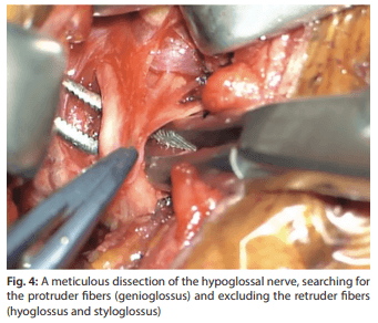 Dissecting hypoglossal nerve