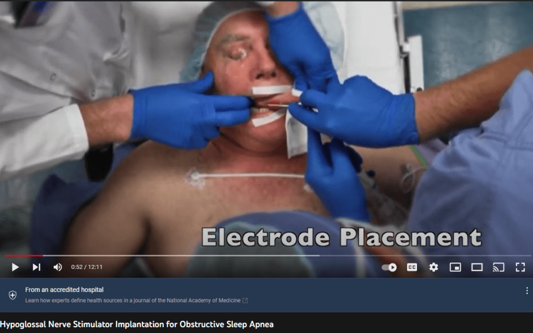 hypoglossal nerve electrode placement